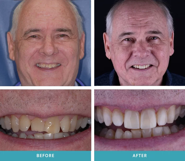 Clear Aligners