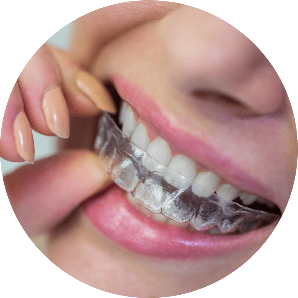 Invisalign Treatment