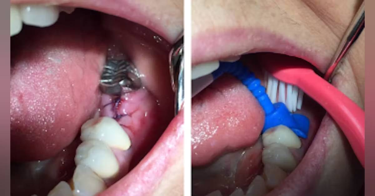 Tooth Extraction