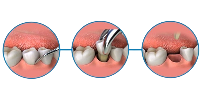 Extraction Procedure