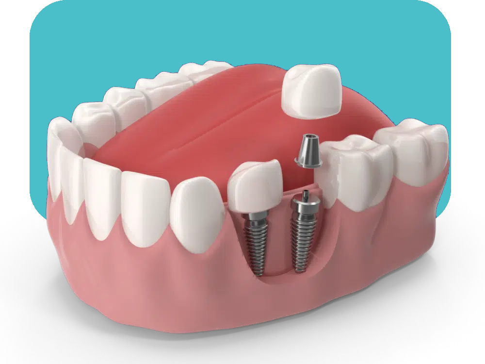 Dental Implants