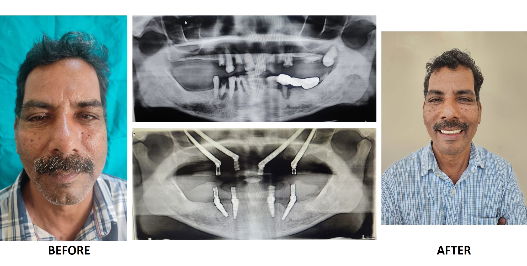 Dental Implants
