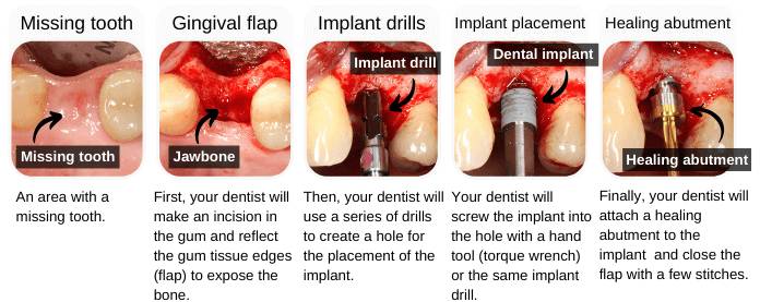 Dental Implant Procedure