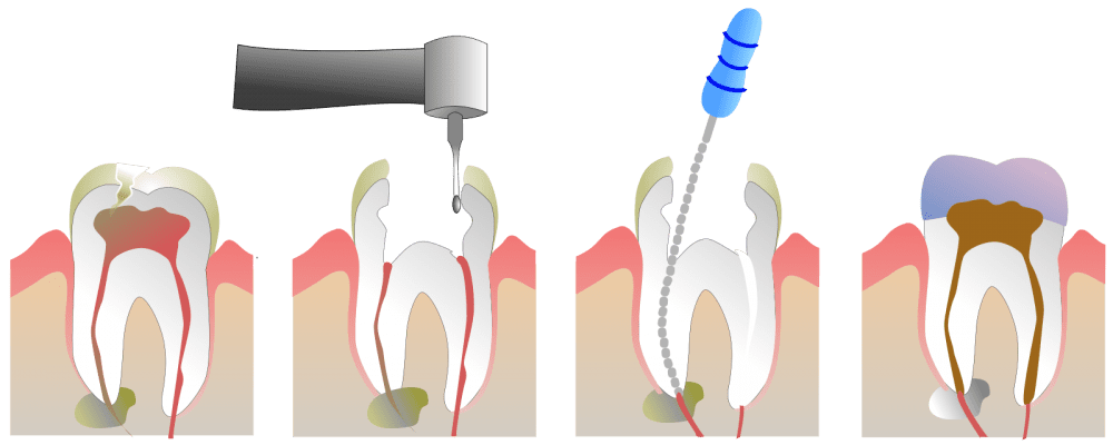 Laser Dentistry Procedure