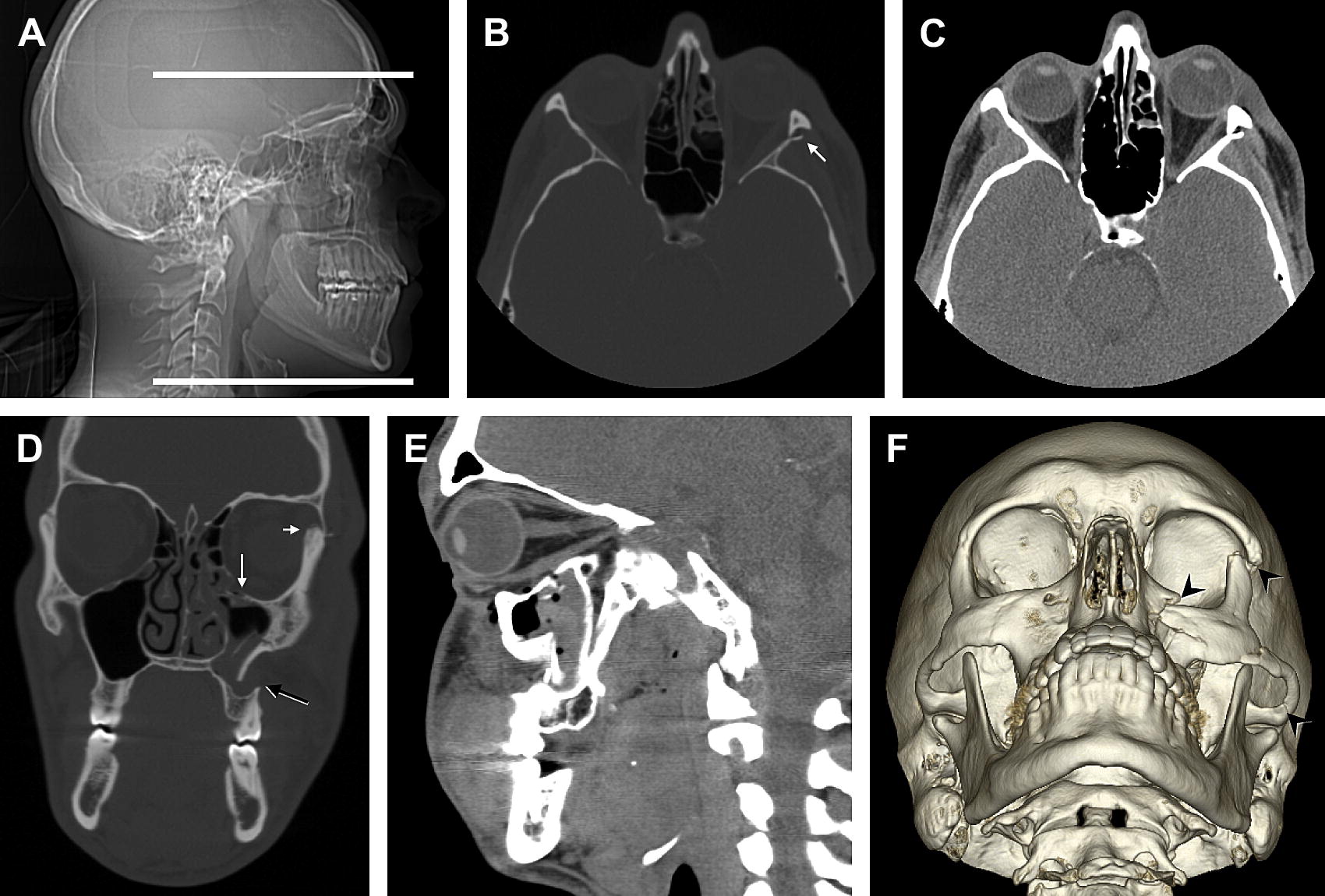 Facio-Maxillary Trauma