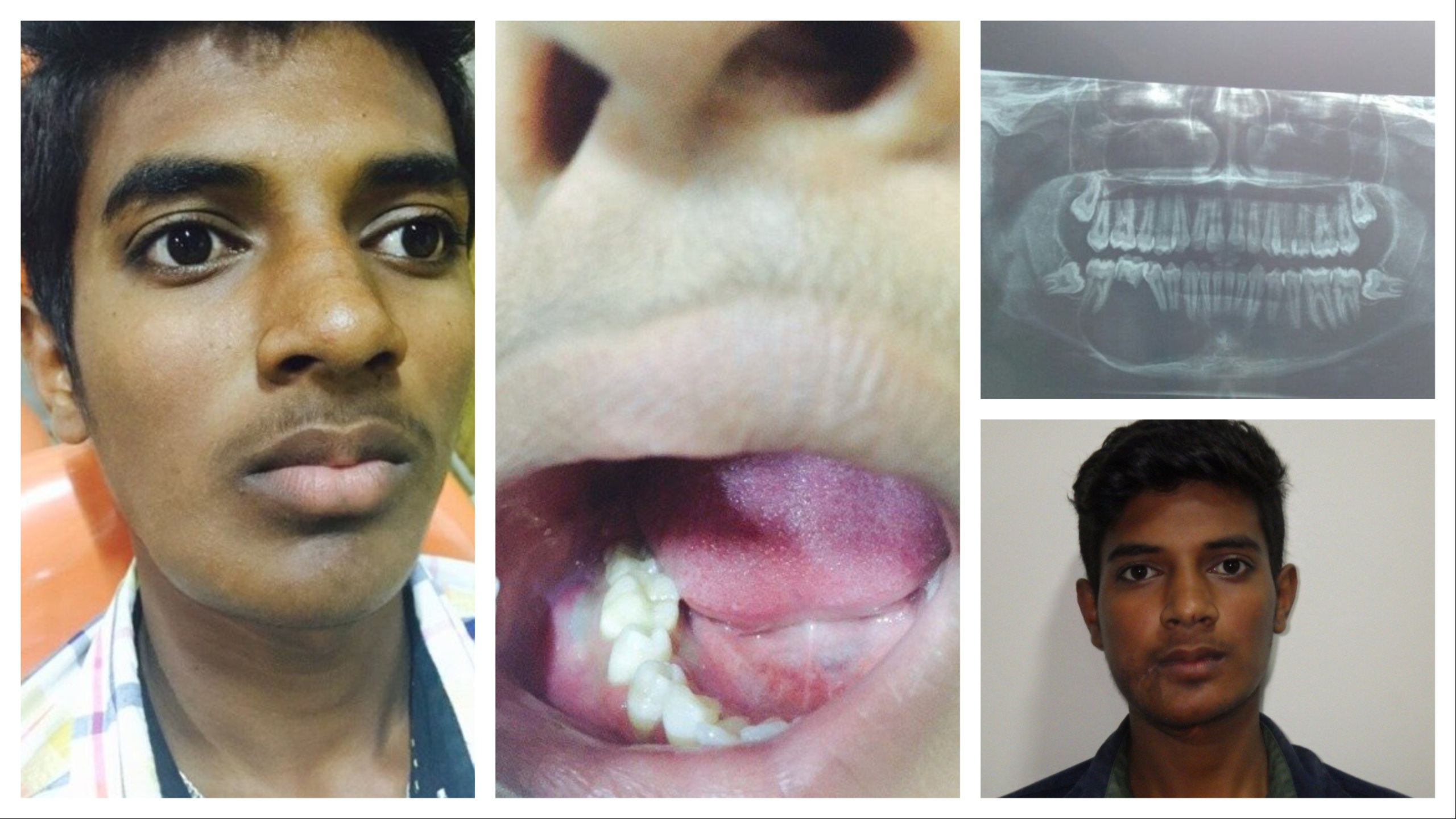 Benign Cysts and Tumours