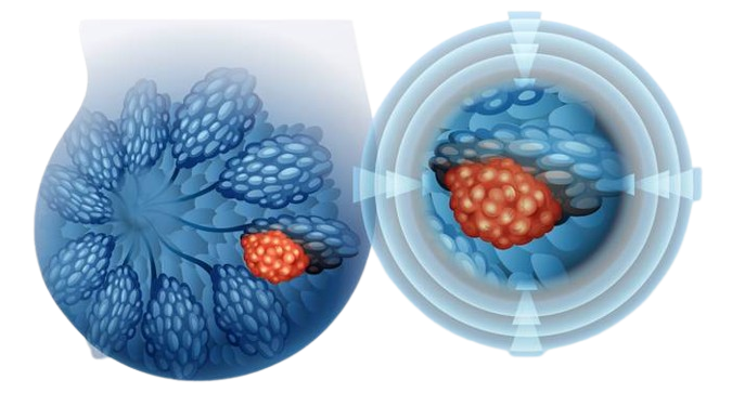 Malignant Tumours