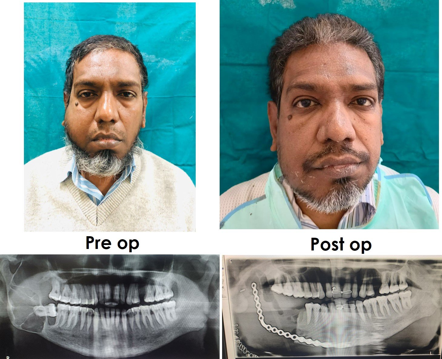 Oral Cancer Treatment