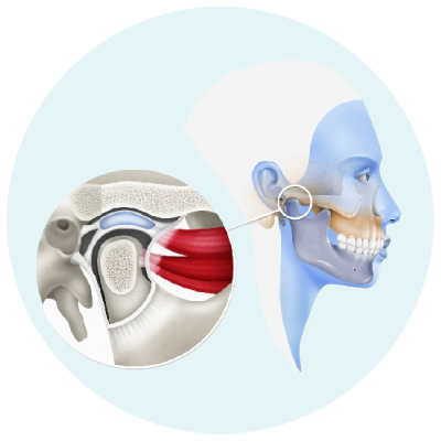 TMJ Surgery