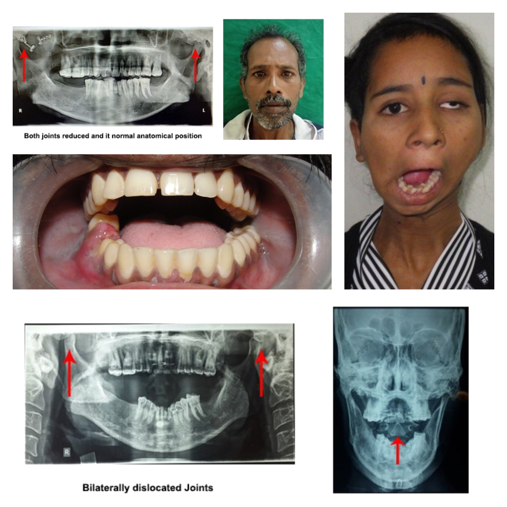 About TMJ Surgery
