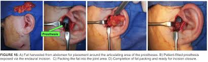 TMJ Procedure